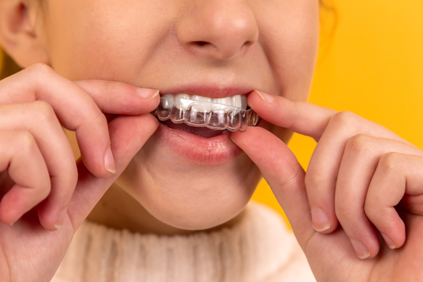 Patient fitting a clear aligner